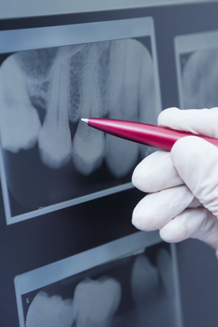 closeup of a dental x-ray