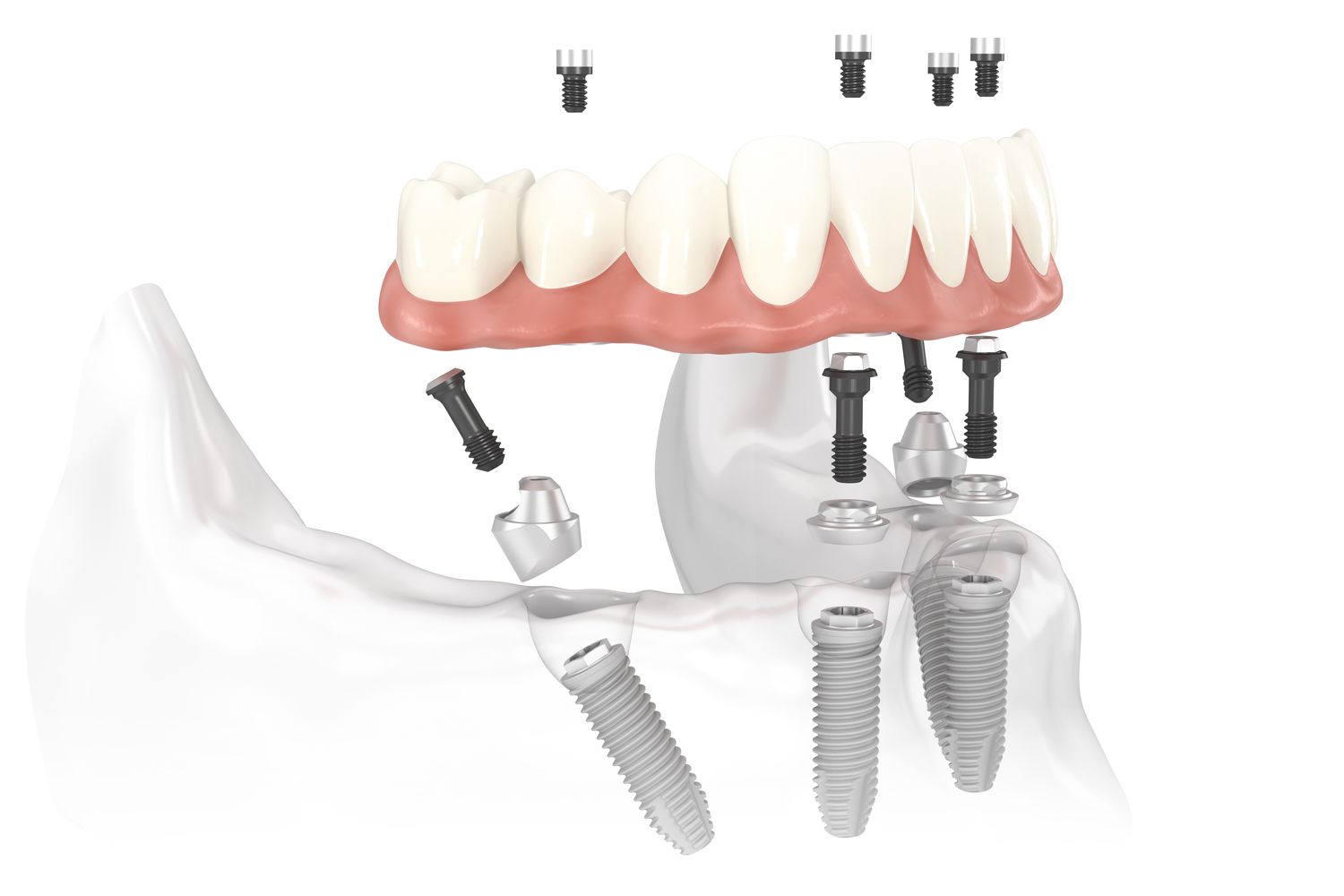 implant-supported dentures