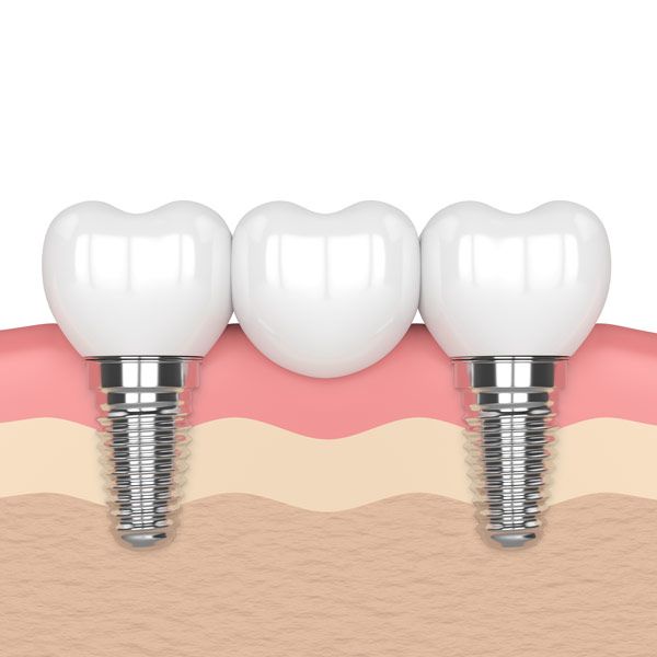 Illustration of implant-supported bridge