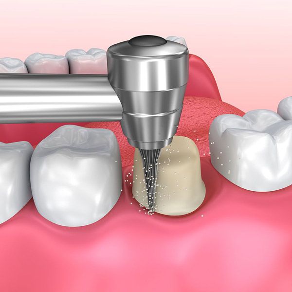Illustration of dental crown preparation