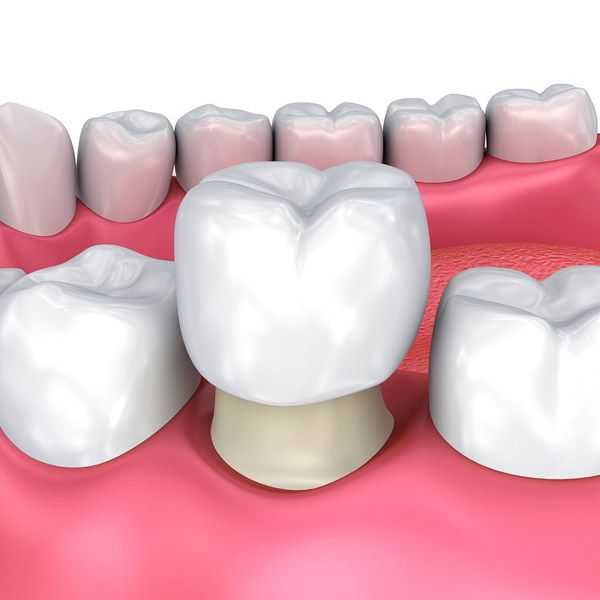 Illustration of traditional dental crown