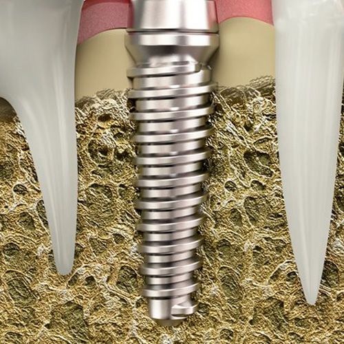 Illustration of implant in jaw